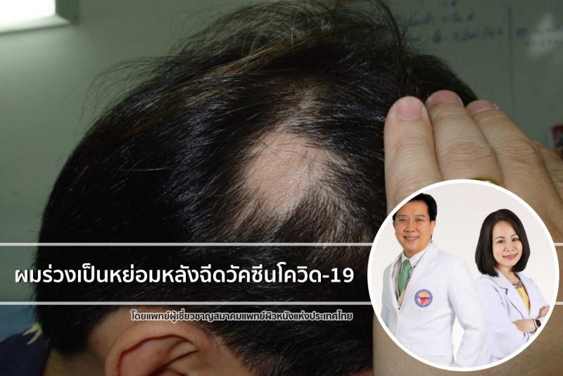 แพทย์ร่วมไขข้อสงสัย ผมร่วงเป็นหย่อมหลังฉีดวัคซีนโควิด-19