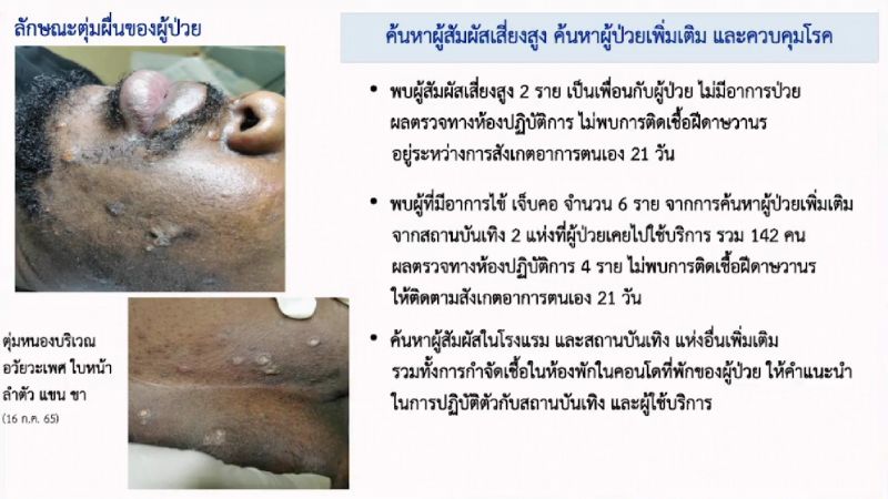 ภูเก็ตบูรณาการติดตามหาตัวผู้ป่วยโรคฝีดาษวานรรายแรกของไทย