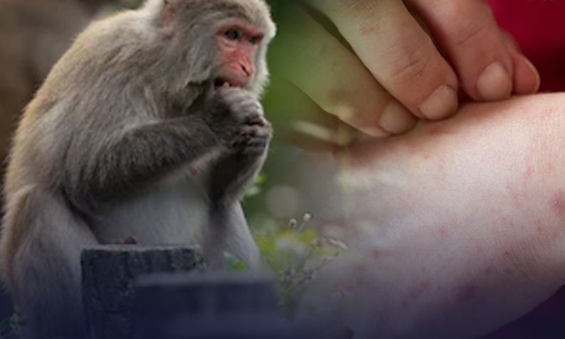 พบผู้ป่วยฝีดาษลิง รายที่ 4 เป็นหญิงไทยใกล้ชิดต่างชาติ